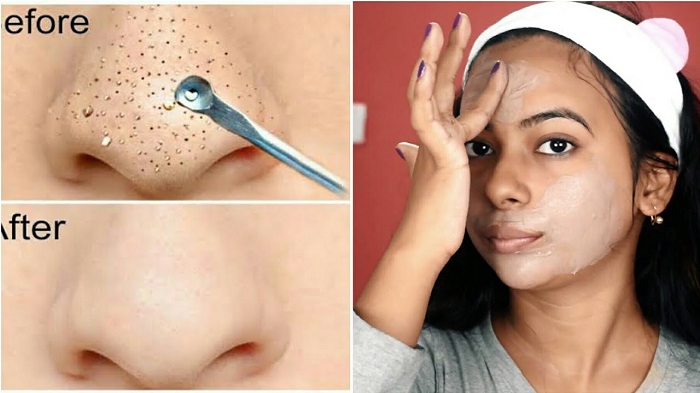 Deep Cleansing Facial For Acne And Hydrodermabrasion